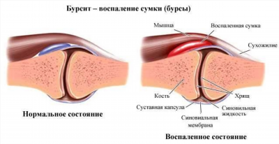 Симптомы и осложнения при гнойном бурсите коленного сустава